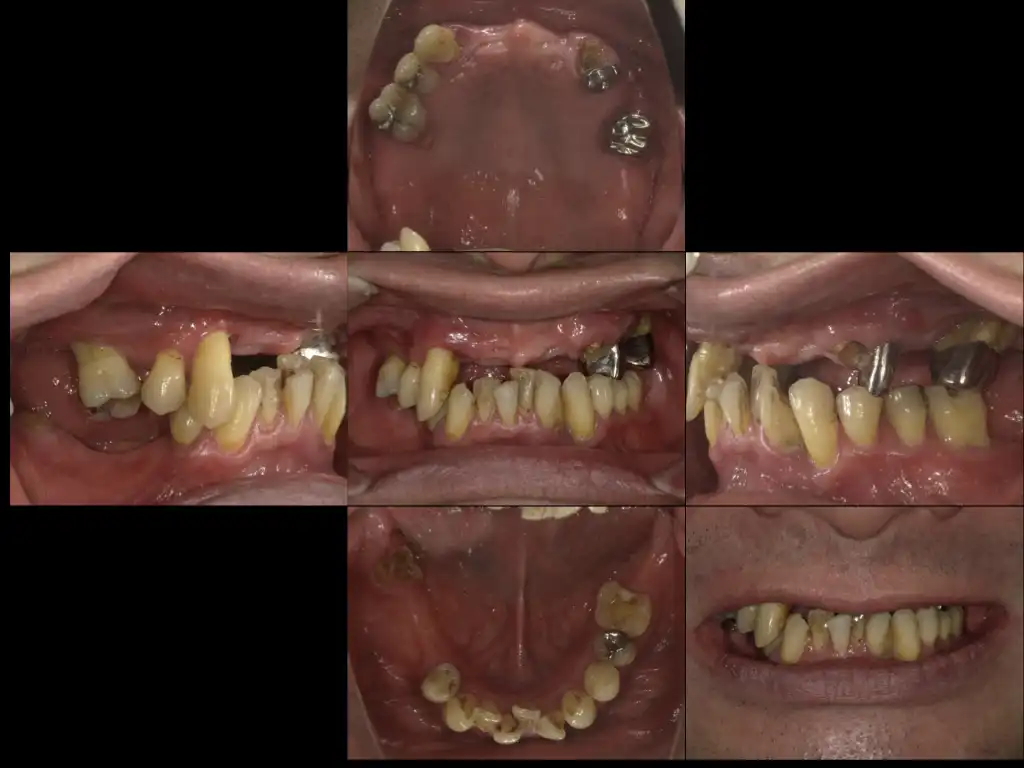 旭川のインプラント治療はエルム駅前歯科クリスタル・オールオンフォー、ザイゴマインプラント、1本から全歯を失った方、老若男女問いません。歯のお悩みはお気軽にご相談ください