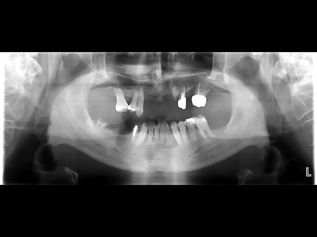 旭川のインプラント治療はエルム駅前歯科クリスタル・オールオンフォー、ザイゴマインプラント、1本から全歯を失った方、老若男女問いません。歯のお悩みはお気軽にご相談ください